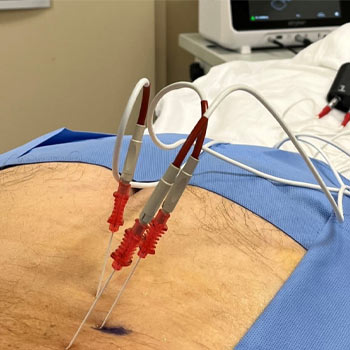 radiofrequency ablation (rfa)